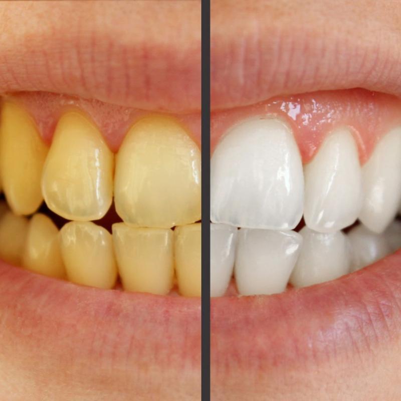 Whitening Diamond Series Strips for Oral Repair - Advanced Solution for a Brighter  and Healthier Teeth dissolving teeth