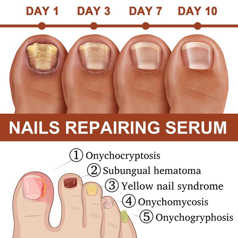 7 Days Nail Strengthening Serum, 2 Counts set Nail Care Essence, Nail Care Product for Women & Men, Professional Nail Strengthening Serum