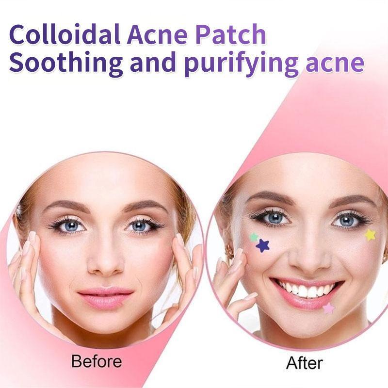 Star Shaped Acne Patch, 1 Bag Waterproof Acne Cover Sticker, Acne Treatment Tool, Skin Care Product for Women & Men